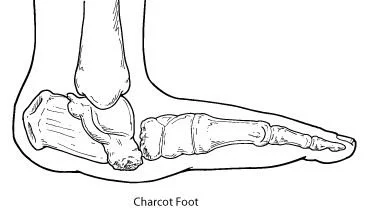 Charcot Charcot